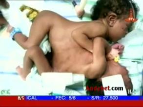 Ethiopian Doctors Separate Conjoined Twins
